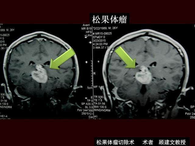 罕见脑内巨大松果体瘤切除术