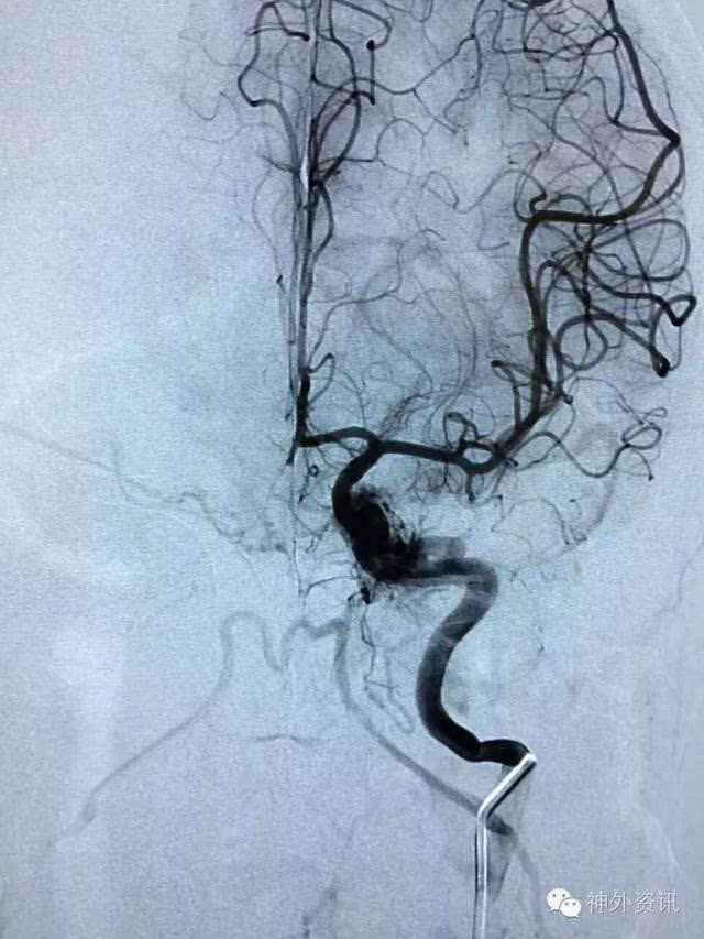 【天新福-神经介入专栏】| 邓剑平教授:海绵窦区动静脉瘘栓塞术1例