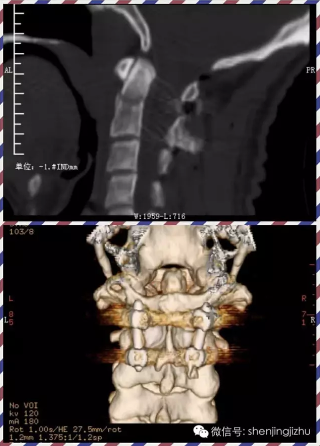 病例分享:枢椎齿状突ii型骨折