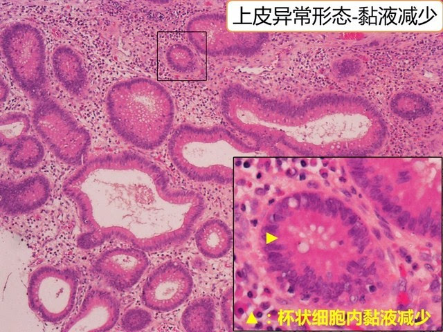 黏液分泌减少(mucin depletion):定义为杯状细胞减少或细胞内黏液