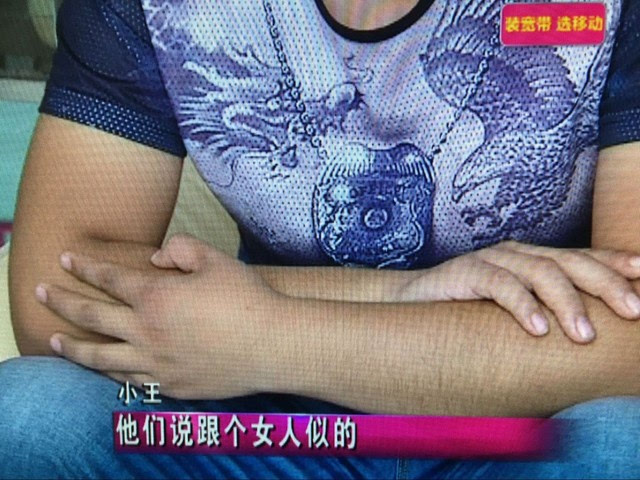 "大胸男"的烦恼 二十三岁小伙患上男性乳房发育症;【天气】"秋老虎"渐