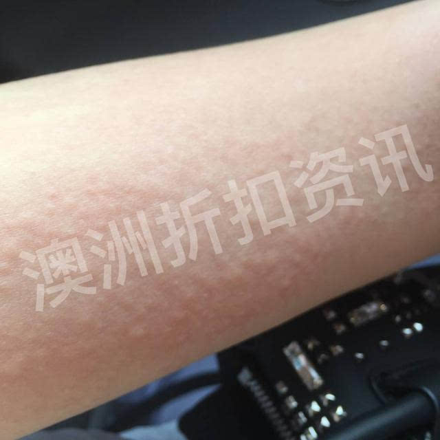 广州造假澳洲水光针窝点被查封,是护肤针还是毁容