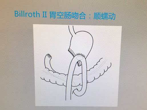 远端胃癌重建 包括以下术式 billroth i 式:三角吻合 billroth