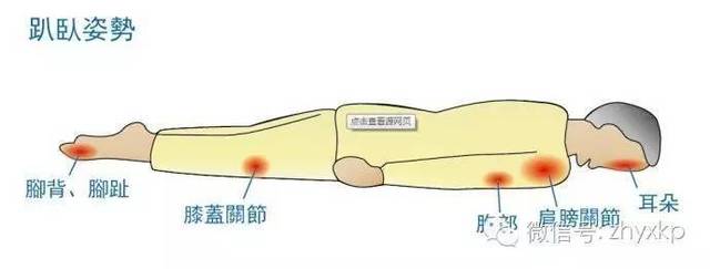 侧卧好发于:耳部,肩峰,肘部,髋部,膝关节内外侧,内外踝.