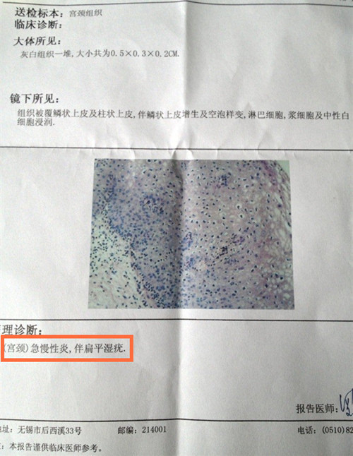 门诊上有些患者做完阴道镜活检后,病理报告显示"宫颈上皮湿疣病变"或"