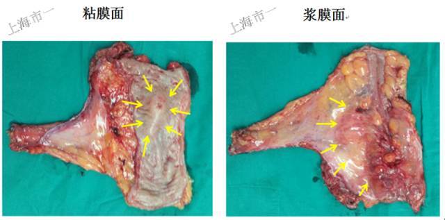 这样的直肠病变可以esd切除吗?