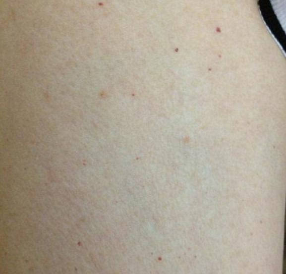 身上起红点只是蜘蛛痣的早期症状,如果身上起红点的蜘蛛痣症状没有