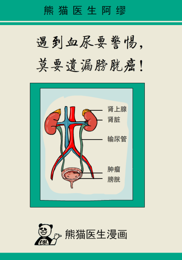 遇到血尿要警惕,莫要遗漏膀胱癌