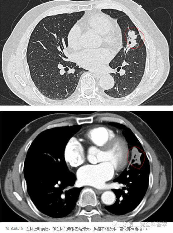 2016-08-15全身pet/ct显像: 左肺上叶舌段肿块,糖代谢异常增高,考虑为