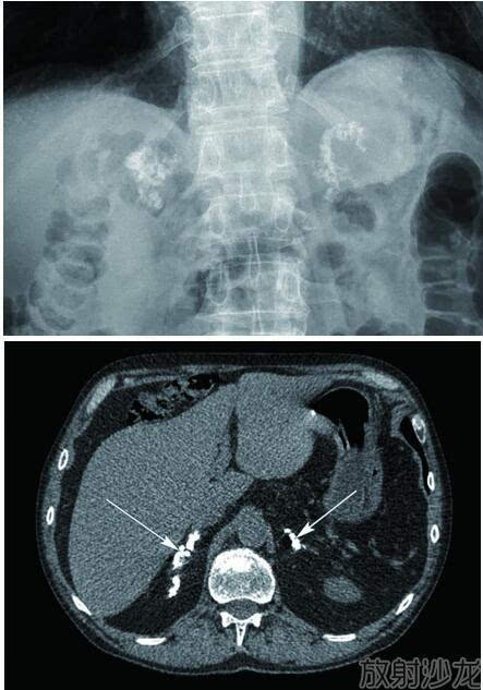 诊断:双侧肾上腺钙化