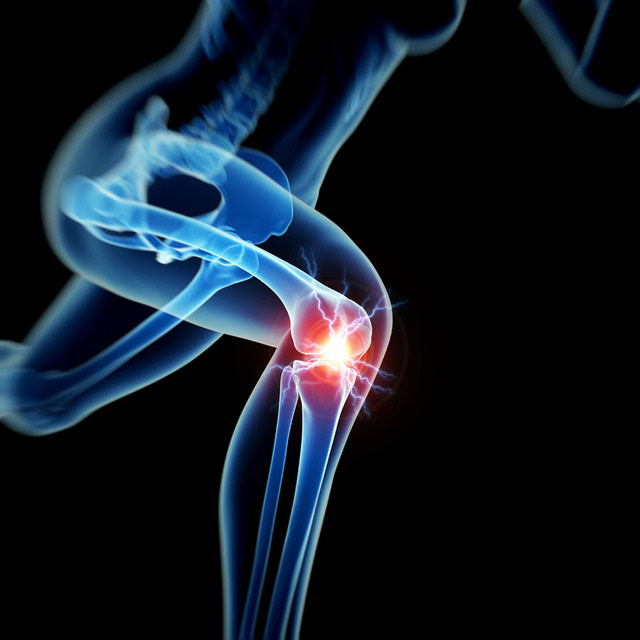 膝关节疼痛为何要警惕股骨头坏死