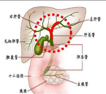 近期同济大学附属杨浦医院普外科收治了1例胆囊癌肝转移致左,右肝管