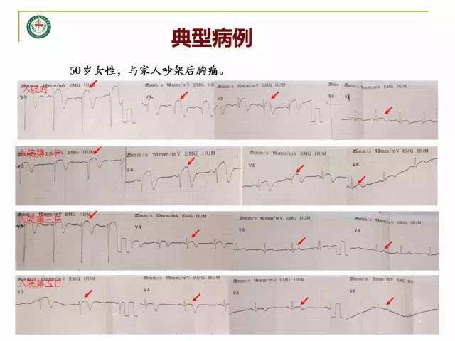 特点: 心电图常见病理性q波并有胸前导联的持续性st-t抬高,超声心动