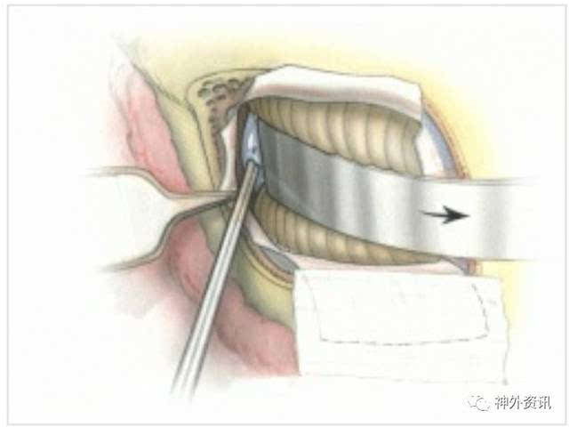 参阅《jackler atl                    窦后入路显露颈静脉孔的美图.