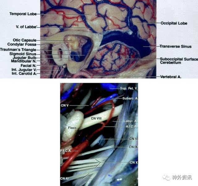 乙状窦后入路| the neurosurgical atlas系列