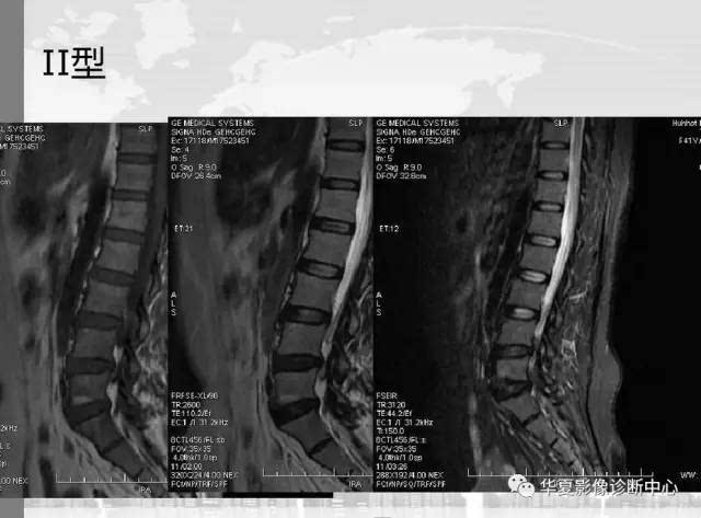 椎体终板炎,怎么看?怎么分? 看完轻松就搞定!