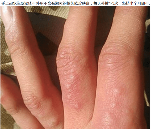 手上水泡型湿疹由什么引起的,从生活细节根除湿疹