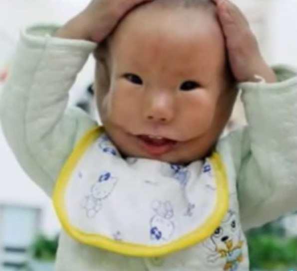 14个月的湖南男孩康康,患有天生横向面裂畸形症状,面部的大裂口一直
