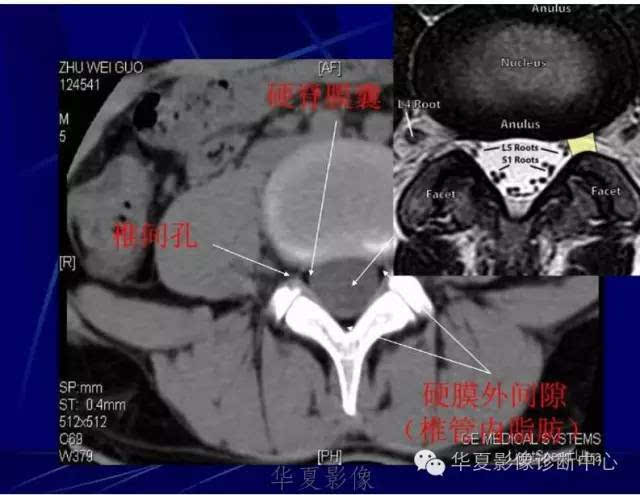 详细的腰椎解剖,椎间盘突出,膨出,看这里