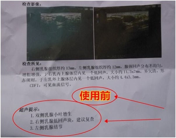 好久前去检查是双侧乳腺小叶增生,左侧乳腺结节,后来过几个月陈来汕