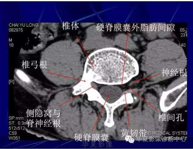 详细的腰椎解剖,椎间盘突出,膨出,看这里