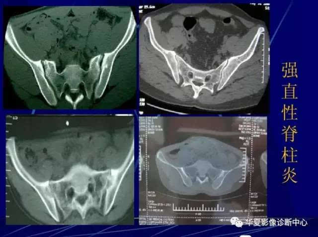 骶髂关节病变的ct区分