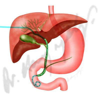 2肝内胆管被肿瘤分隔成多腔,不能引流整个胆管系统者. 2.3.