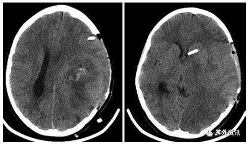 头颅ct显示去骨瓣减压之后继续nivolumab治疗,发展成严重脑水肿和