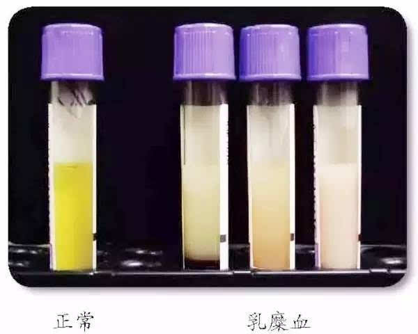 4,白色血液 当血液中血脂过多,血液可呈白色,俗称乳糜血.