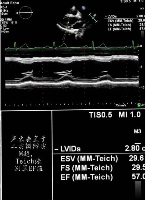 总的来说,心脏超声测算ef值的方法有三种:m超,simpons 法和三维测定