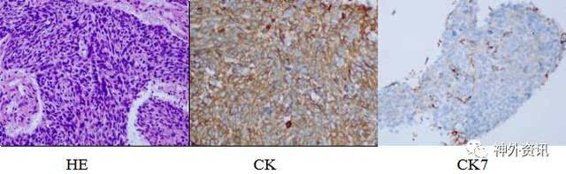 免疫组化ck弥漫强阳性,ck7散在阳性.