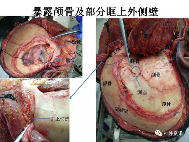 手术视频| 刘振林教授团队:sta-m3搭桥,复发听神经瘤切除手术,dolenc