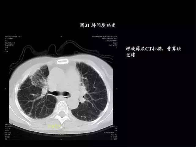 史上最全肺ct分段及典型疾病影像-健康频道-手机搜狐
