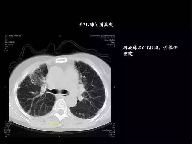 史上最全肺ct分段及典型疾病影像