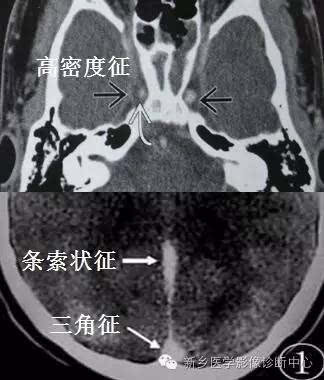 一文读懂静脉窦血栓的几大征象