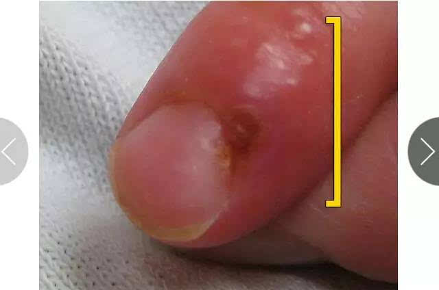 所导致的皮肤相关临床表现也多种多样,如上图箭头所示的寻常疣,掌跖疣