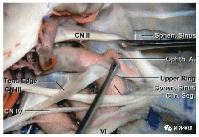 床突旁动脉瘤| the neurosurgical atlas全文翻译