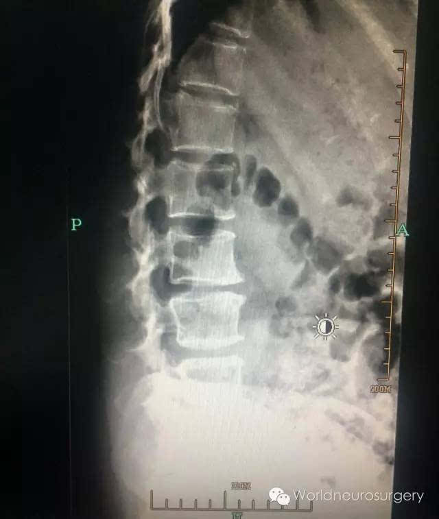 因为据统计腰椎穿刺点在椎间隙上一棘突的下缘较下一棘突的上缘穿刺