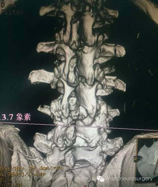 腰麻穿刺怎样才能"一针见水"?秘诀就这6条!