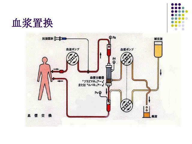 专家谈血浆置换疗法