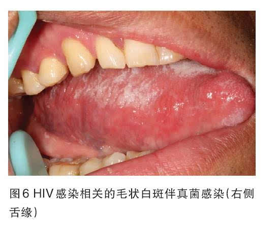 其中伪膜型念珠菌病是预示疾病将从无症状hiv感染期进入aids阶段的