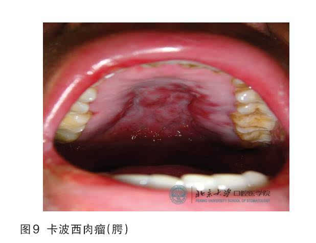 发生于口腔的卡波西肉瘤最常见于上腭黏膜,其次是牙龈.