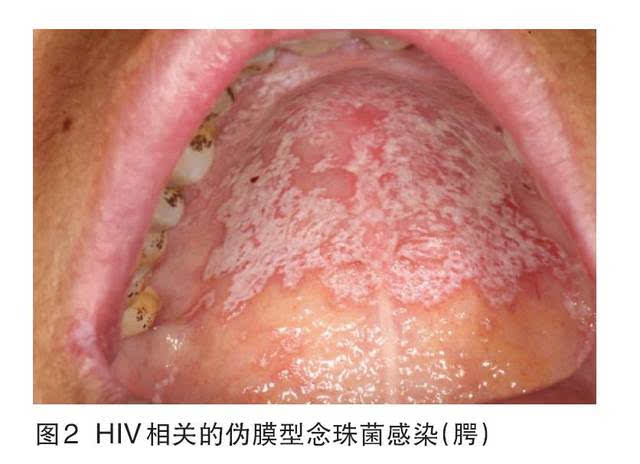hiv感染和aids患者发生的口腔念珠菌病可分为:红斑型,伪膜型,口角炎型