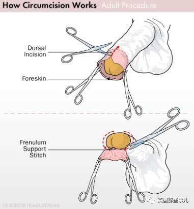 想象一下,如果某天 你在波士顿的一家医院做包皮手术 医生问你: "嗯