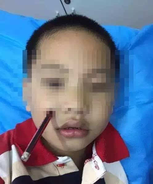一岁娃吃玉米,筷子从鼻腔插向颅底 无独有偶,就在医院收治这名小男孩