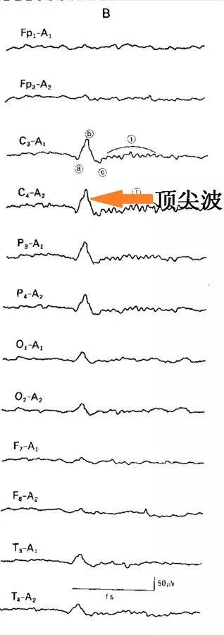 有两个特征性的波:k复合波和睡眠纺锤波.