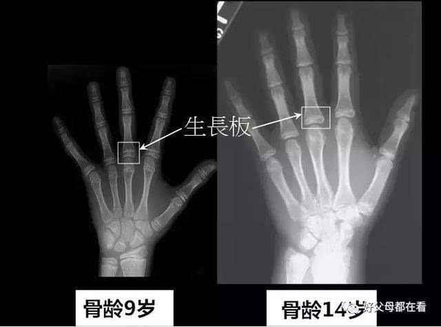 青春期之前就去照一张左手掌的x光片,之后每年定期拍一张的骨龄照片