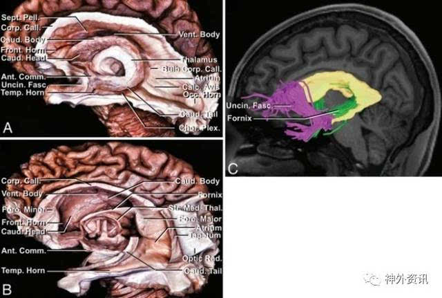 大脑白质纤维束与侧脑室手术(一)