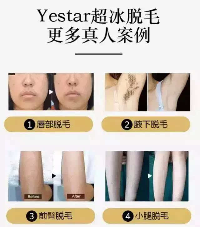 万人点击! yestar武汉艺星99元脱毛活动被