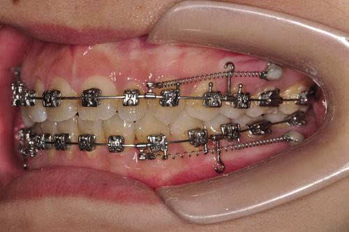 5)怕必须戴一些装置与打骨钉 牙齿矫正的临床操作常会配合运用到一些